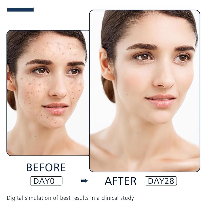 Dark Spot Remover for Face and Body - Dark Spot Advanced Corrector Serum for Melasma, Age Spots, Freckles & Sun Spots, with 360° Roller for All Skin Types