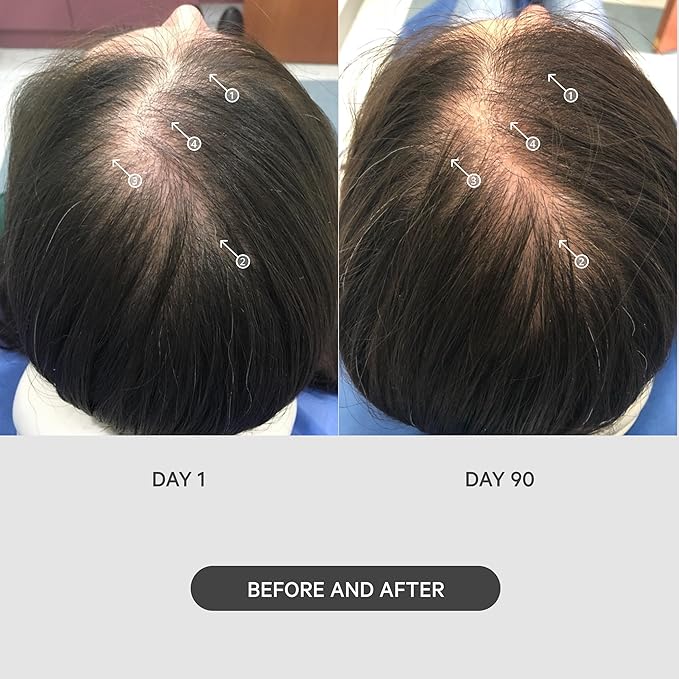 DS Labs StimuROLLER Hair Micro-Needle Hair Stimulation System 0.25mm, Packaging May Vary