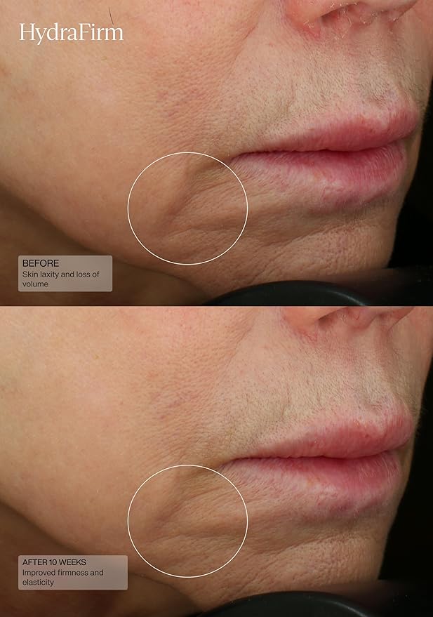 Senté HydraFirm Serum | Supports Collagen and Elastin Production | Restores Firmness and Volume | Formulated with Patented HSA and Peptides | 1 Fl Oz