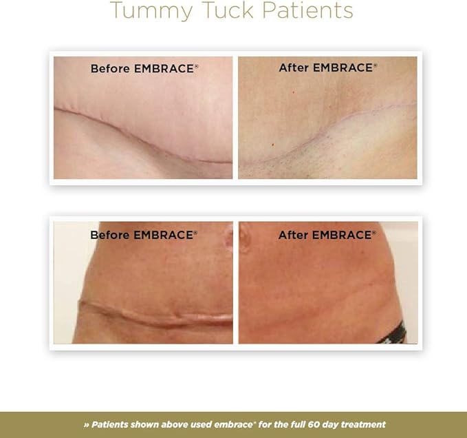 Embrace Active Scar Defense for New Tummy Tuck Scars, FDA-Cleared Extra-Large Silicone Scar Sheets, 30 Day Supply