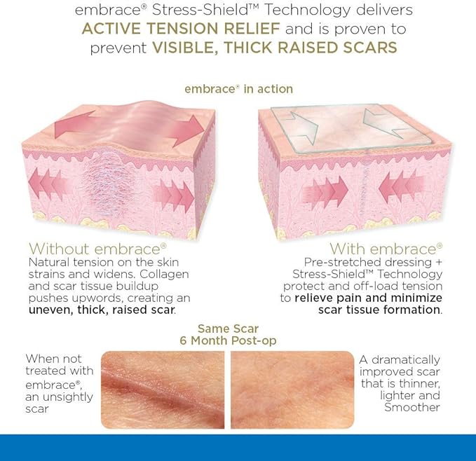Embrace Active Scar Defense for New Scars, FDA-Cleared Medical-Grade Silicone Scar Sheets for Hypertrophic & Keloid Scar Treatment, 4.7 Inch, Large, 30-Day Supply