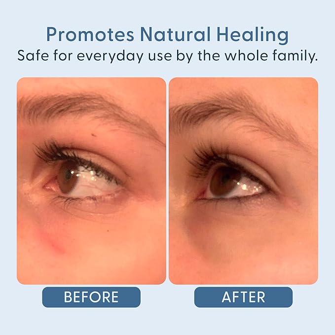 twenty/twenty Easy On The Eyes – 0.02% Hypochlorous Acid Spray to Cleanse Eyelashes – Reduce Eyelid Irritation – Safe for Sensitive Skin – Ophthalmologist Developed–Vegan, Clean Ingredients – 60ml