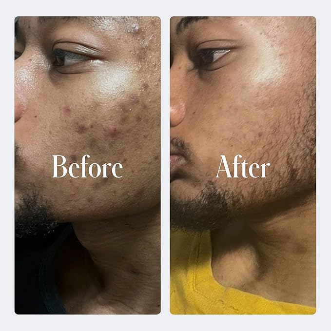 Geologie Clear System | 3-Step Acne Treatment & Skincare Set | Clears Skin Fast | Acne Gel Cleanser, SPF15 Day Cream & Retinol Face Cream For Men & Women | Month 1 / Level 1