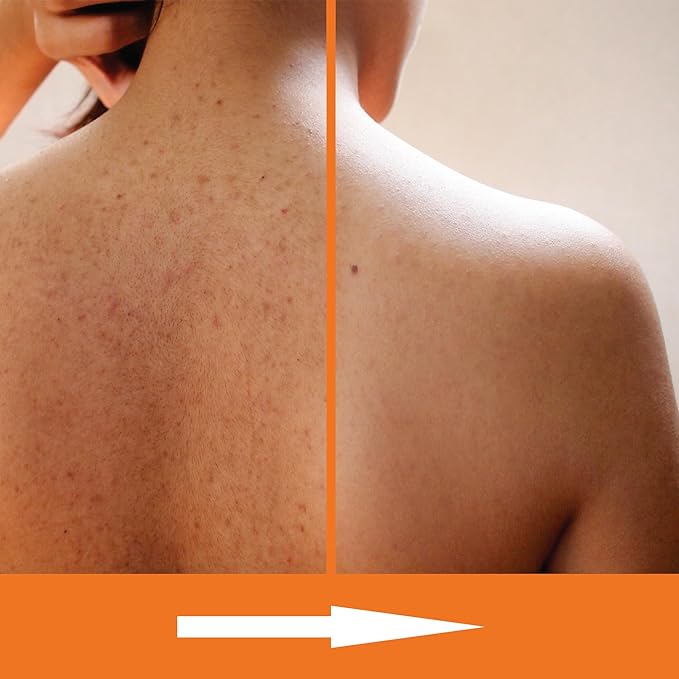 Salicylic Acid Body Wash - Skin Non-drying, Gentle Exfoliates Rough and Bumpy Skin, Body Acne Wash, BHA & AHA - Unscented Exfoliating Body Wash, Made in USA - (16 fl oz x 2)