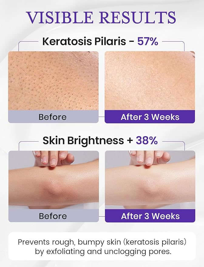 Elvira KP Bump Eraser Foot & Body Scrub, Exfoliating Scrub for Keratosis Pilaris, Smooth Skin with 10% AHA BHA & Niacinamide, Deep Moisturizing Cleanser for All Skin Types, Exfoliante para el Cuerpo