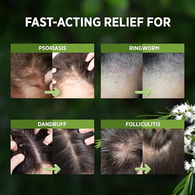 RoyceDerm Tea Tree Scalp Relief Spray: Leave-In Scalp Care for Dry, Flaky, and Itchy Scalp - Tea Tree Oil Formula for Comfort, Hydration, and Balance - Conditioning Support for Women & Men