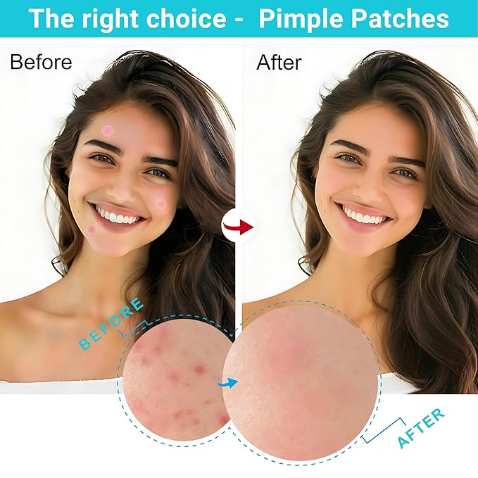 Miracle Patch - Invisible Pimple Patches for Face & Body,Fast-Acting Zit Stickers, Hydrocolloid Acne Treatment with Tea Tree Oil & Salicylic Acid–Waterproof, Hypoallergenic. 96 Counts 3 Sizes