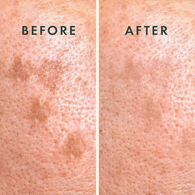 Rael Pimple Patches, Miracle Microcrystal Vitamin C Dark Spot Cover - Hydrocolloid Patch with Glutathione and Niacinamide, Treatment for Post Acne, Korean Skin Care, Vegan, Cruelty Free (9 Count)