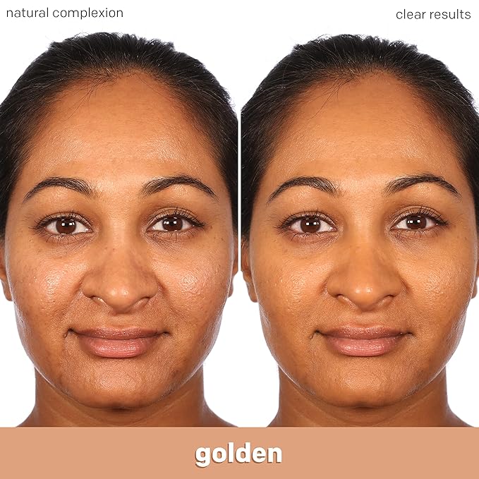 Almay Clear Complexion Acne Foundation Makeup with Salicylic Acid - Lightweight, Medium Coverage, Hypoallergenic, Fragrance-Free, for Sensitive Skin, 730 Golden Caramel, 1 fl oz.